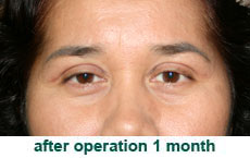 plastic-surgery-blepharoplasty